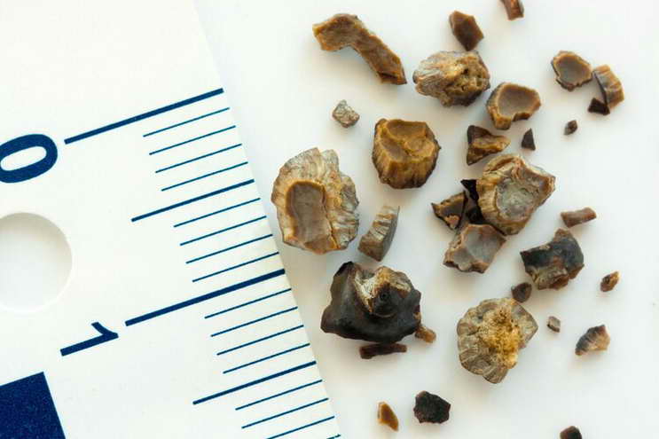 膽結石怎麼吃？再次勸告你：6類食物禁忌，四級預防讓你遠離結石