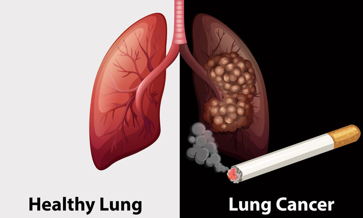 肺癌一查就是晚期？其实双腿早已给了提示，只是大多数人都忽略了
